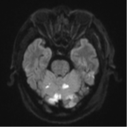 Blunt cerebrovascular injury (Radiopaedia 53682-59745 Axial DWI 41).png