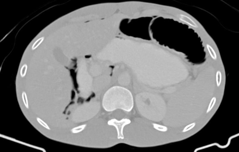 Blunt injury to the small bowel (Radiopaedia 74953-85987 Axial Wide 17).jpg