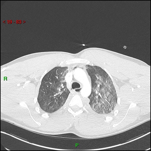 Blunt thoracic trauma (Radiopaedia 73454-84221 Axial lung window 30).jpg