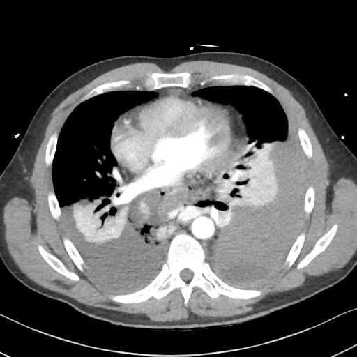 File:Boerhaave syndrome (Radiopaedia 39382-41661 A 33).png