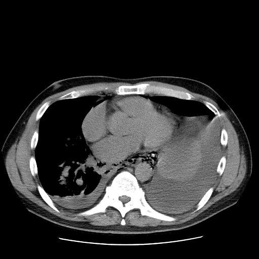 Boerhaave syndrome (Radiopaedia 59796-67310 Axial liver window 39).jpg