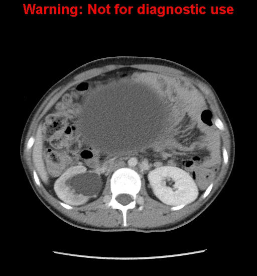 Borderline mucinous cystadenoma of ovary (Radiopaedia 25586-25767 A 7).jpg