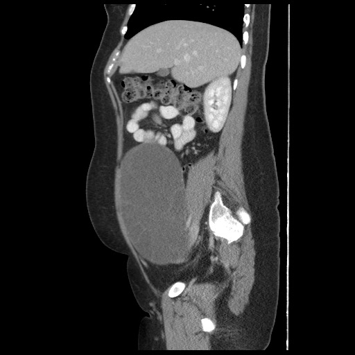 File:Borderline mucinous tumor (ovary) (Radiopaedia 78228-90808 B 24).jpg