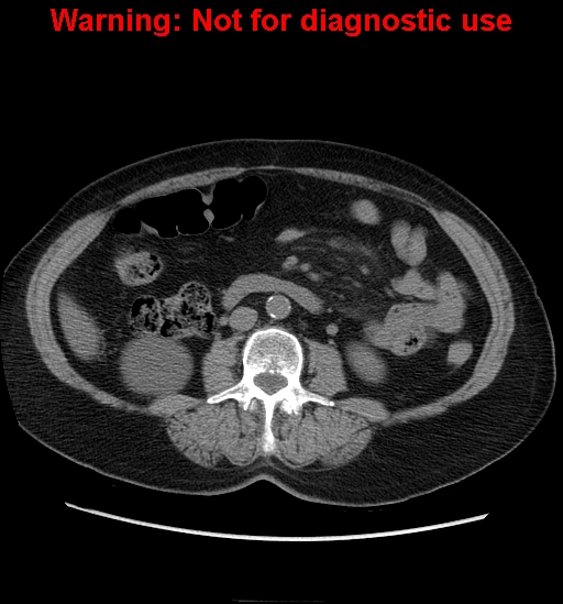 File:Bosniak renal cyst - type II (Radiopaedia 23404-23468 Axial non-contrast 21).jpg