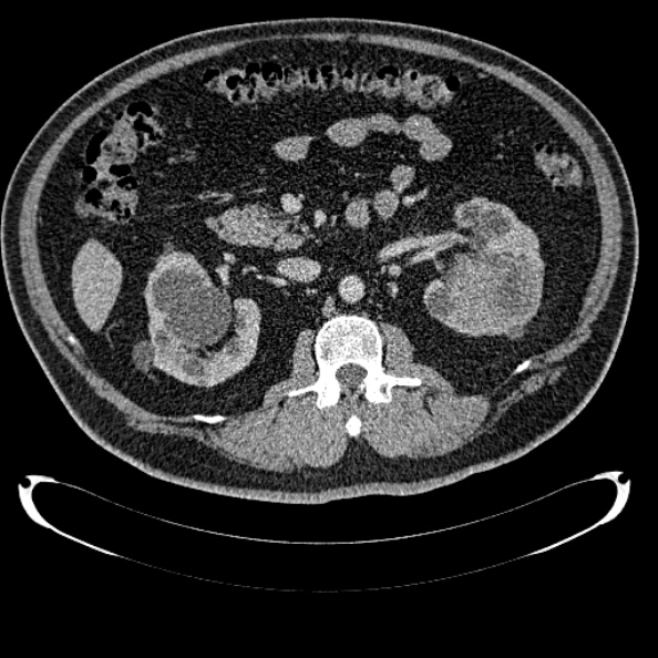 Bosniak renal cyst - type IV (Radiopaedia 24244-24518 C 147).jpg