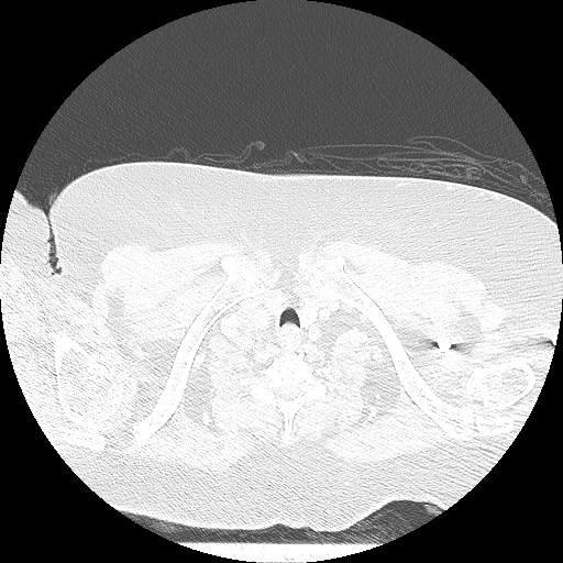 Bovine aortic arch - right internal mammary vein drains into the superior vena cava (Radiopaedia 63296-71875 Axial lung window 1).jpg