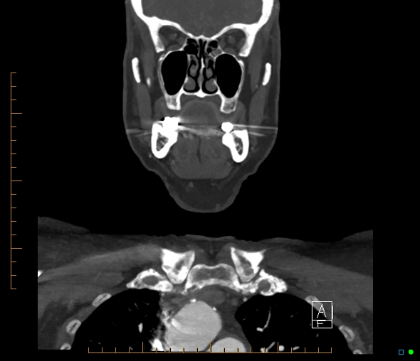 Brachiocephalic trunk stenosis (Radiopaedia 87242-103519 B 18).jpg