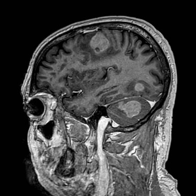 Brain metastases from lung cancer (Radiopaedia 83839-99028 Sagittal T1 C+ 48).jpg