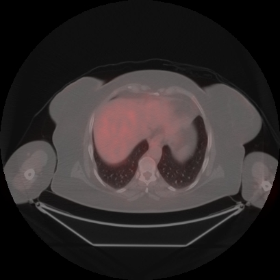 Brain metastasis (Radiopaedia 89847-106962 Axial lung window 49).jpg