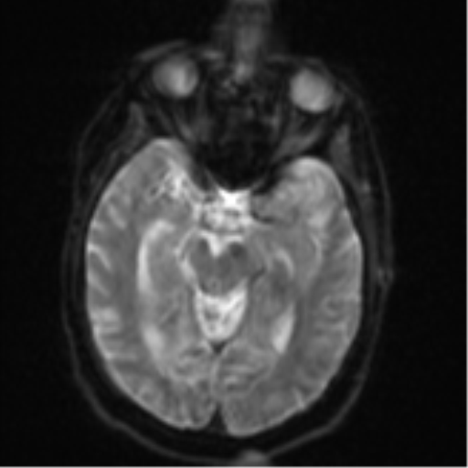 Brain metastasis (lung cancer) (Radiopaedia 48289-53179 Axial DWI 11).png