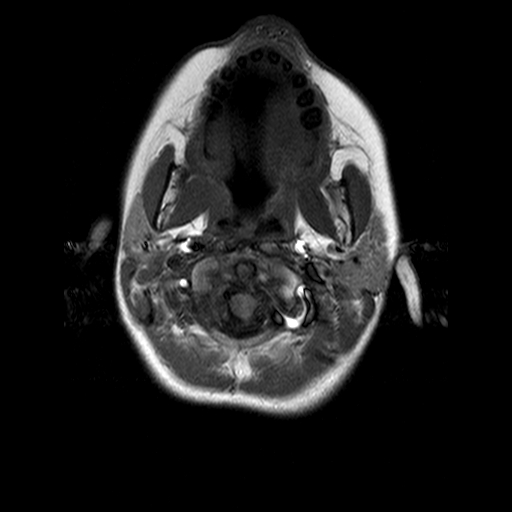 File:Brainstem ganglioglioma (Radiopaedia 10763-11224 Axial T1 19).jpg