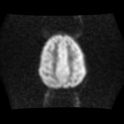 File:Brainstem glioma (Radiopaedia 30923-31624 Axial DWI 14).jpg