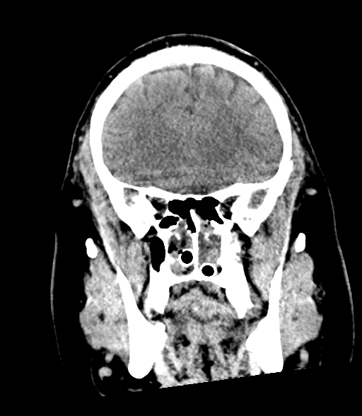 File:Brainstem hemorrhage (Radiopaedia 81294-94976 Coronal non-contrast 20).jpg