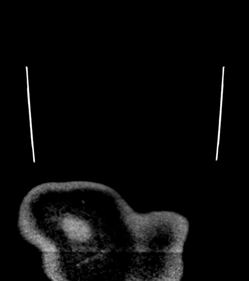 File:Branchial cleft cyst (Radiopaedia 31167-31875 Coronal C+ delayed 72).jpg