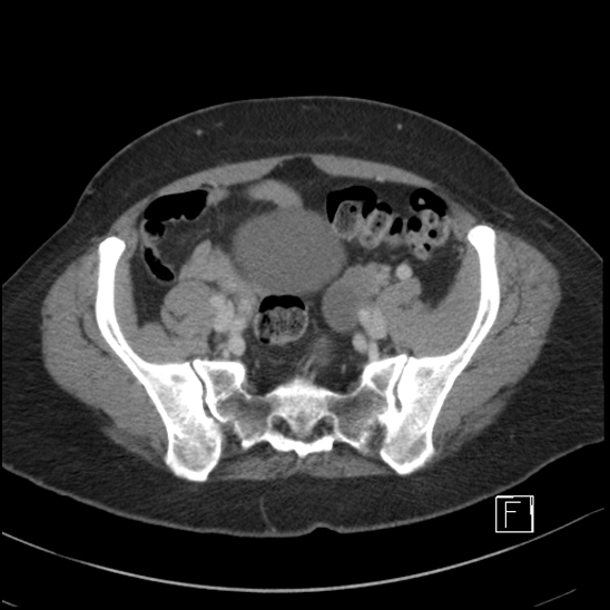 File:Breast metastases from renal cell cancer (Radiopaedia 79220-92225 C 88).jpg
