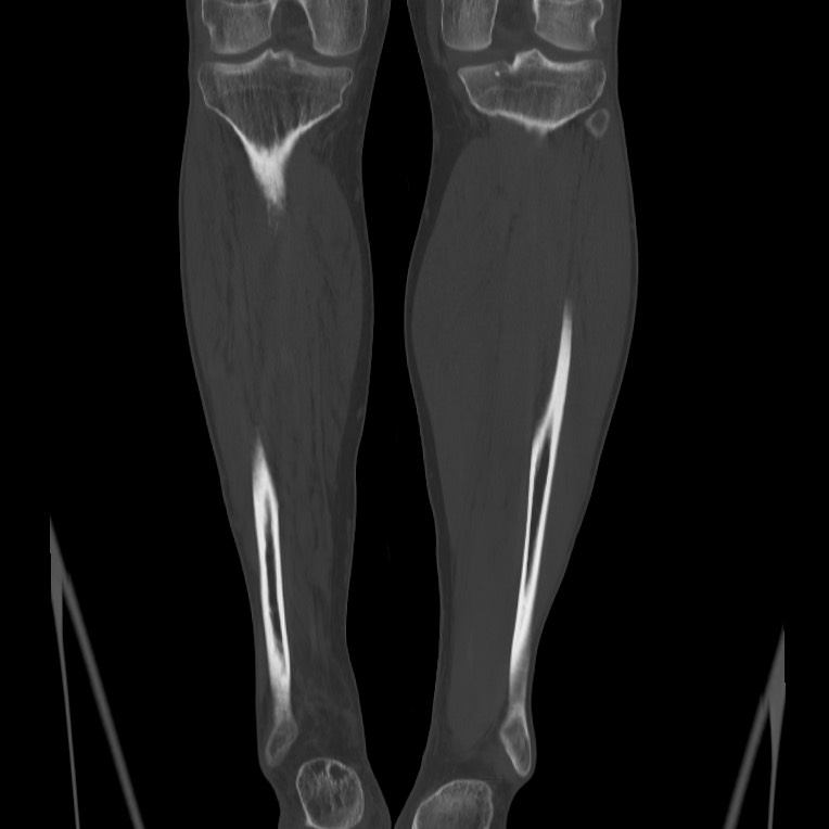 Brodie abscess - tibia (Radiopaedia 66028-75204 Coronal bone window 52).jpg