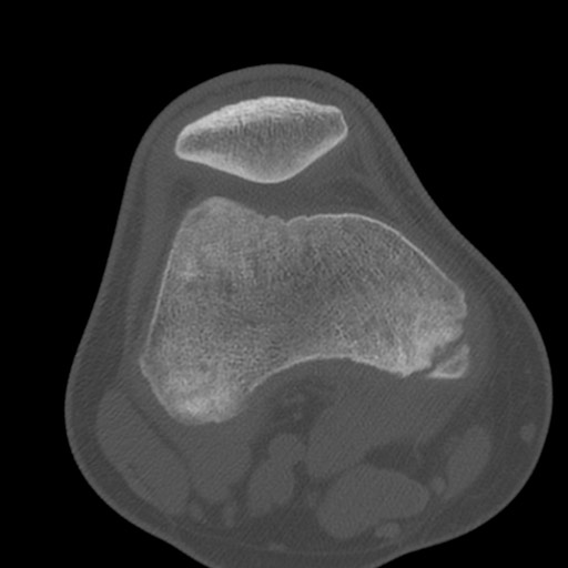 Brodie abscess of the tibia (Radiopaedia 58984-66250 Axial bone window 30).jpg