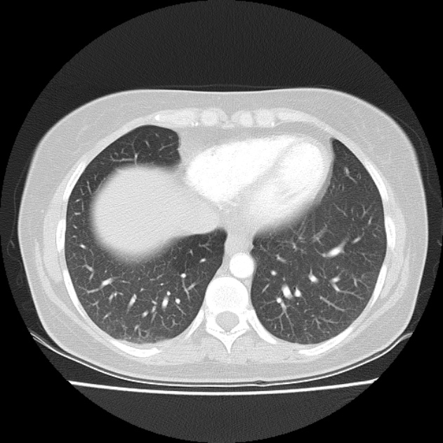 Bronchial atresia (Radiopaedia 22965-22992 Axial lung window 15).jpg