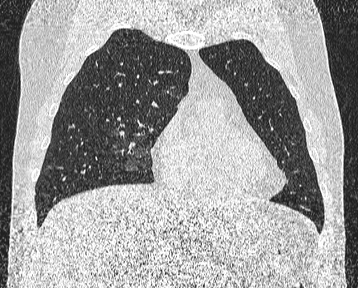 Bronchial atresia (Radiopaedia 58271-65417 Coronal lung window 15).jpg