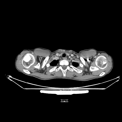 Bronchial carcinoid tumor (Radiopaedia 57187-64090 A 1).jpg