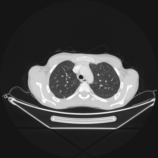 Bronchial carcinoid tumor (Radiopaedia 57187-64090 Axial lung window 17).jpg