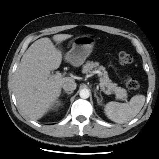 Bronchial carcinoid tumor (Radiopaedia 67377-76764 A 62).jpg