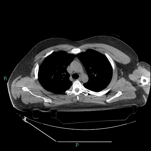 File:Bronchial carcinoid tumor (Radiopaedia 78272-90870 Axial non-contrast 33).jpg