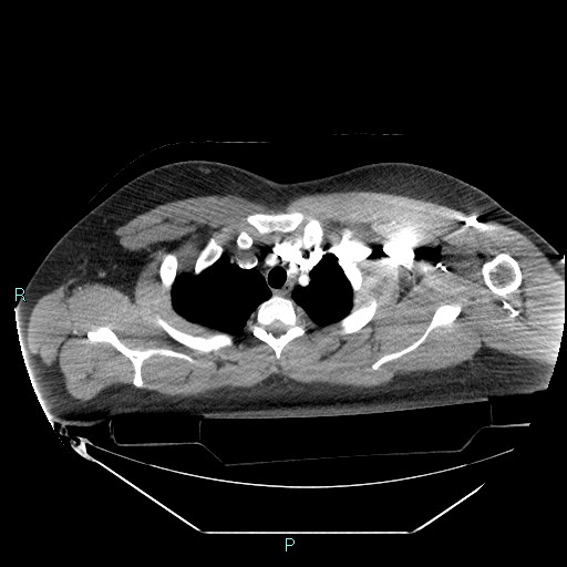 Bronchial carcinoid tumor (Radiopaedia 78272-90870 B 26).jpg