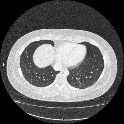 Bronchial carcinoid tumor (Radiopaedia 78272-90875 Axial lung window 38).jpg