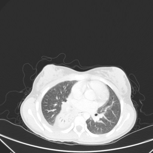 Bronchial mucoepidermoid carcinoma (Radiopaedia 57023-63895 Axial lung window 58).jpg