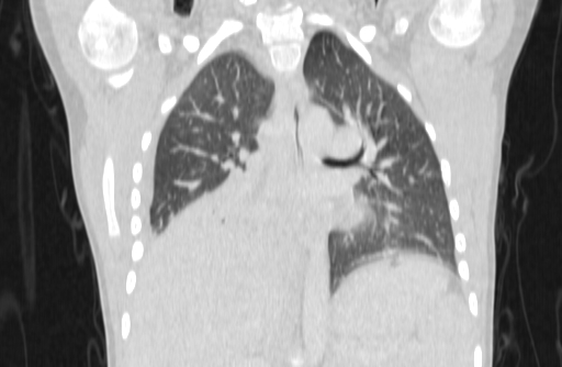 Bronchial mucoepidermoid carcinoma (Radiopaedia 57023-63895 Coronal lung window 30).jpg