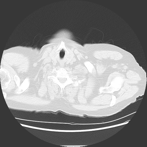 Bronchial stenosis - lung transplant (Radiopaedia 73133-83848 Axial lung window 2).jpg
