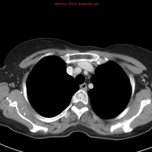 File:Bronchoalveolar carcinoma (BAC) (Radiopaedia 13436-13392 B 11).jpg