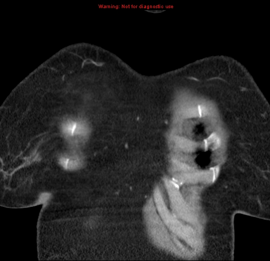 Bronchoalveolar carcinoma (BAC) (Radiopaedia 13436-13392 E 4).jpg
