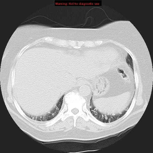 Bronchoalveolar carcinoma (Radiopaedia 13224-13233 Axial lung window 36).jpg