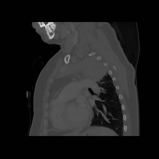 Bronchogenic carcinoma (Radiopaedia 73497-84262 Sagittal bone window 102).jpg