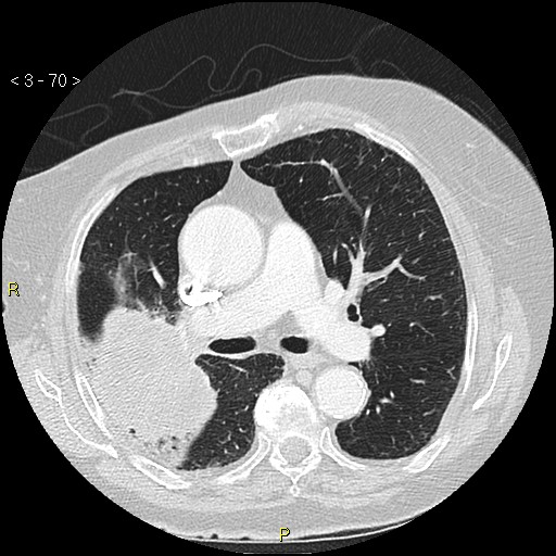 File:Bronchogenic carcinoma as an incidental finding (Radiopaedia 16453-16130 Axial lung window 70).jpg