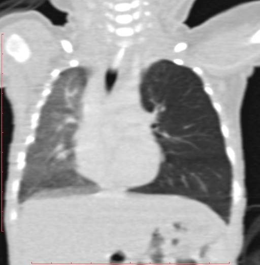 Bronchogenic cyst (Radiopaedia 78599-91409 Coronal lung window 112).jpg