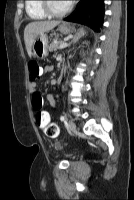 Brown tumors compressing the spinal cord (Radiopaedia 68442-77988 F 34).jpg