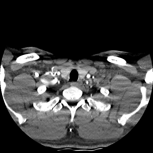 Buccal fat pad arteriovenous malformation (Radiopaedia 70936-81144 D 47).jpg