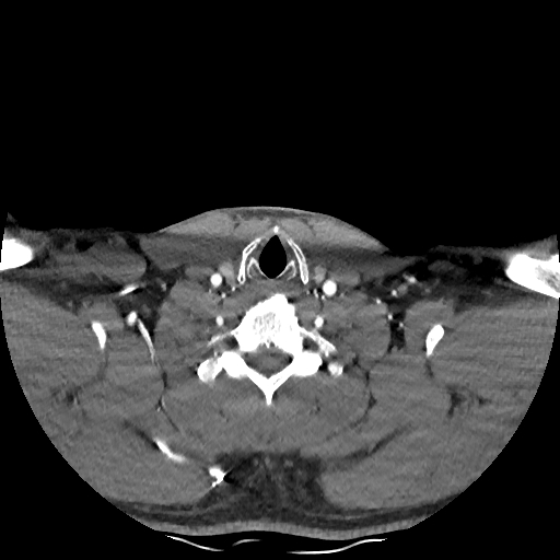Buccal fat pad arteriovenous malformation (Radiopaedia 70936-81144 D 77).jpg