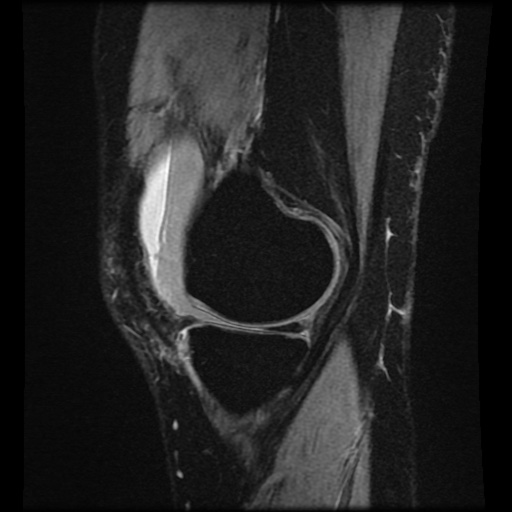 Bucket handle meniscus tear (Radiopaedia 56916-63751 H 63).jpg