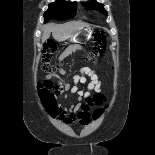 Burned-out testicular seminoma - retroperitoneal nodal metastases (Radiopaedia 62872-71245 B 16).jpg