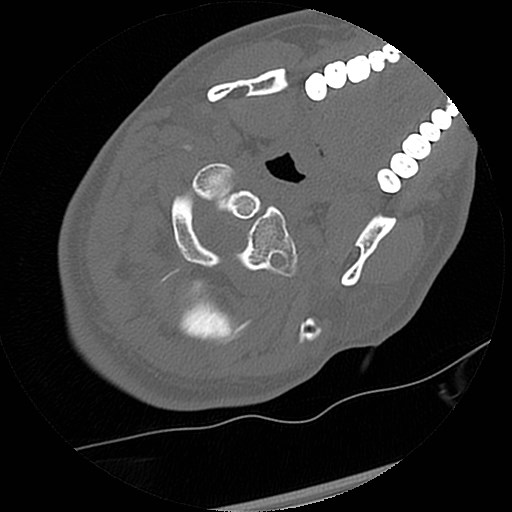 C1-C2 "subluxation" - normal cervical anatomy at maximum head rotation (Radiopaedia 42483-45607 Axial non-contrast 50).jpg