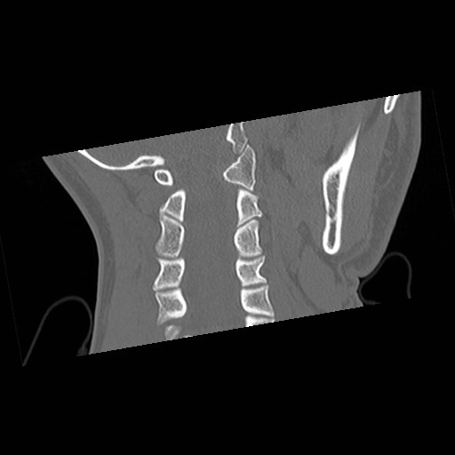 C1-C2 "subluxation" - normal cervical anatomy at maximum head rotation (Radiopaedia 42483-45607 Coronal non-contrast 31).jpg