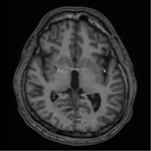 CNS vasculitis (Radiopaedia 55715-62263 Axial T1 26).png