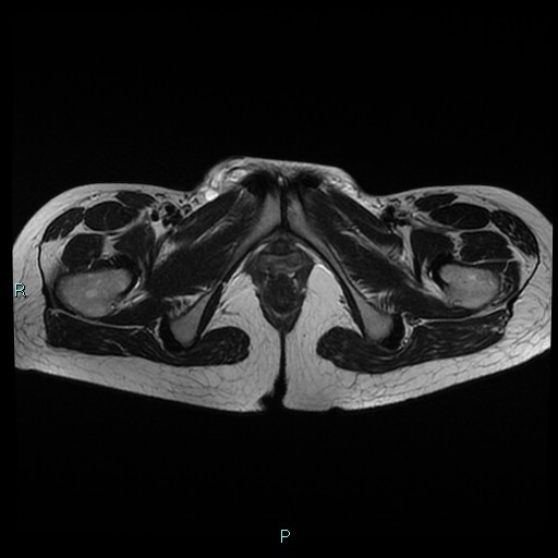 File:Canal of Nuck cyst (Radiopaedia 55074-61448 Axial T2 21).jpg