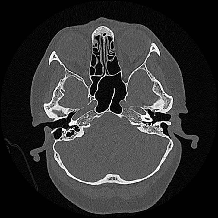 Canal up mastoidectomy (Radiopaedia 78108-90638 Axial bone window 60).jpg