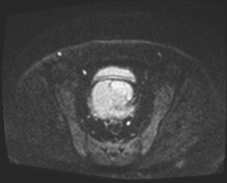 Cancer cervix - stage IIb (Radiopaedia 75411-86615 Axial DWI 45).jpg