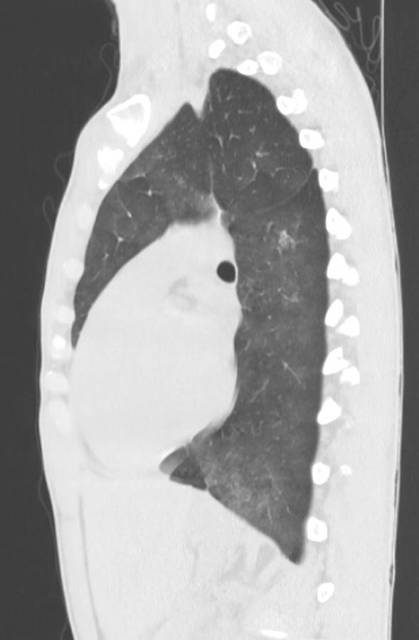 Cannabis-induced diffuse alveolar hemorrhage (Radiopaedia 89834-106946 Sagittal lung window 82).jpg